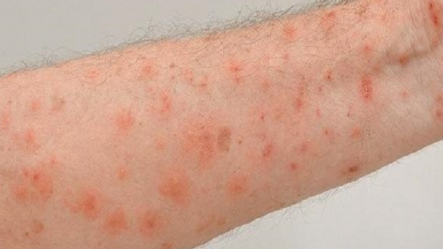 Alerta em São Mateus após surto de sarna humana em Nestor Gomes