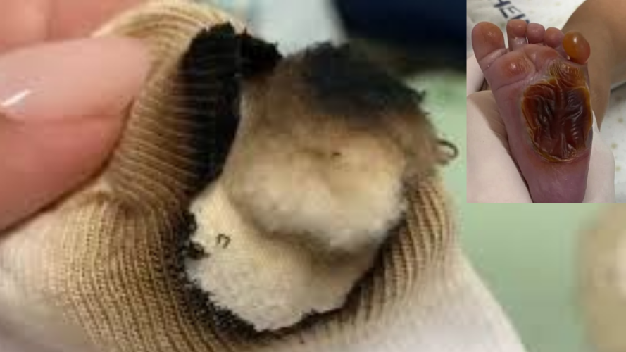 Recém-nascido sofreu queimadura em hospital da Serra